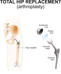 types of hip surgery