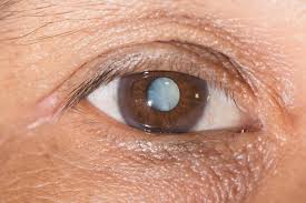 white spots on the eye 5 common causes
