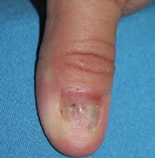 nail emergencies springerlink