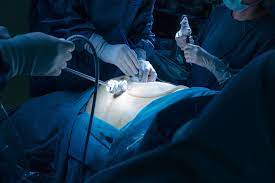 hiatal hernia surgery what to expect