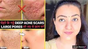 deep acne scars