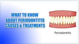 what to know about periodonis