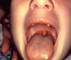 strep throat pictures what does strep