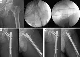 intertrochanteric femur fractures