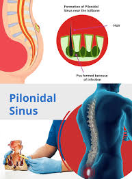 endoscopic pilonidal sinus treatment