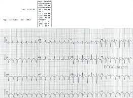 Otherwise symptoms may include palpitations, feeling lightheaded, sweating, shortness of breath, and chest pain. Sinus Tach Or Svt 4 Clues To Tell The Difference