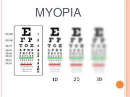 Myopia Control Merideneyecare Com