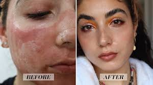 acne scars beauty photos trends