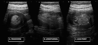 cureus ileal lipoma as a leading