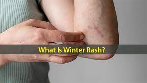 what is winter rash causes symptoms
