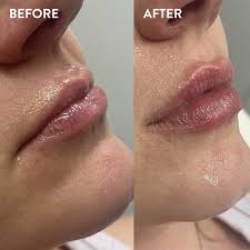 injectables before and after