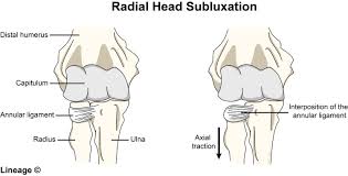 Radial Head Subluxation Orthopedics Medbullets Step 2 3