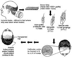 Hair Transplant Surgery 101 A Typical Procedure Start To
