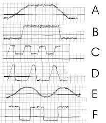 Continuous Fever Wikipedia