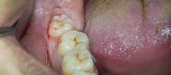 wisdom teeth symptoms hermie