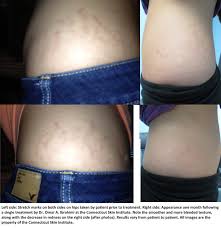 stretch mark reduction connecticut
