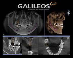 dental implants 3d cone beam imaging