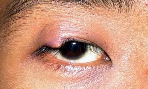 stye or chalazion what to do about