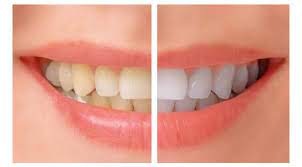 Most of the common teeth whitening products you can buy at the store use a diluted hydrogen peroxide solution to bleach your teeth white. Get White Teeth Overnight Health Gadgetsng