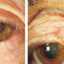 common types of benign eyelid tumors a