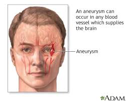 aneurysm in the brain information