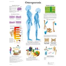 Osteoporosis Chart