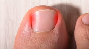 ingrown toenail remes you can do at