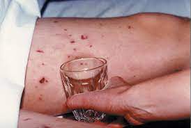 Meningitis is an inflammation of the tissue around the spinal cord and brain; Meningitis Glass Test Meningitis Rash Test Meningitis Now