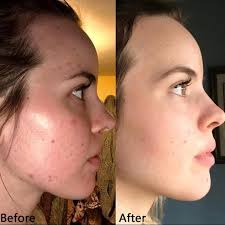 It's supposed to be a gentle acid which is more of a cream formulation rather i really wish i had taken before and after photos, as just after 6 weeks there is already a huge noticeable difference. Shopify Ksa 3 Pieces The Ordinary Hyaluronic Acid 2 B5 Facebook