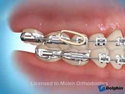 How long it did take for you to have your teeth perfectly aligned ? Underbite Correction Using Rubber Bands Youtube Braces Rubber Bands Braces Tips Orthodontics
