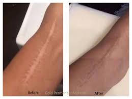 gold permanent makeup scars burns