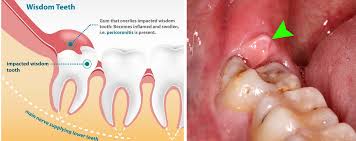 wisdom tooth extraction or removal