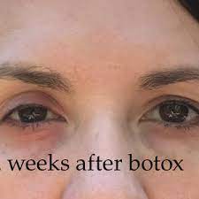 eyelid drooping ptosis from botox