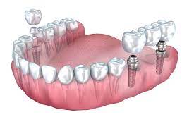 dental bridge vs implant cost dental