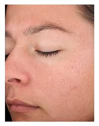 Before we go into details, however, let us start by mentioning that the point here is not to get rid of pores altogether. Open Pore Treatments London Get Causes Solutions Costs And Before Afters