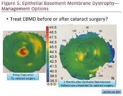 Before Cataract Surgery