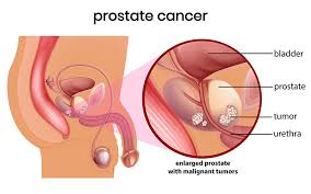 prostate cancer symptoms diagnosis