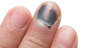 black fingernail symptoms causes