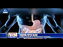 how to treat peptic ulcer health focus