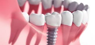 Are Dental Implants For You? Learn More - Sedation Dentist, Dental Implants Monmouth County NJ