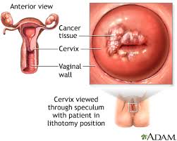 It is thought that something damages or alters certain genes in the cell. Cervical Cancer Medlineplus Medical Encyclopedia