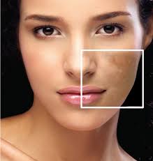 skin pigmentation condition