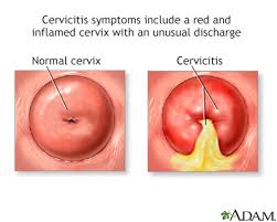 cervicitis information mount sinai