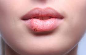 daunting pimples on lips
