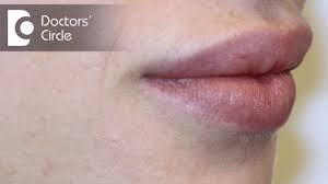 causes of white spots on lips dr