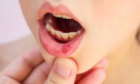 home remes to cure mouth ulcers