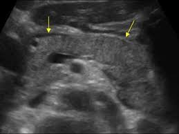 To better elucidate the complex findings on ultrasound  an MRI was obtained 