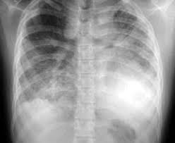Idiopathic pulmonary fibrosis (ipf) is a rare lung disease that causes scar tissue to grow inside your lungs. Insuficiencia Respiratoria Progresiva Secundaria A Fibrosis Pulmonar En Una Escolar Caso Clinico