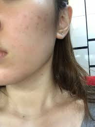 brown acne pigmentation on the face