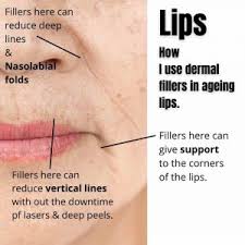 wrinkles peri mouth dr davin lim
